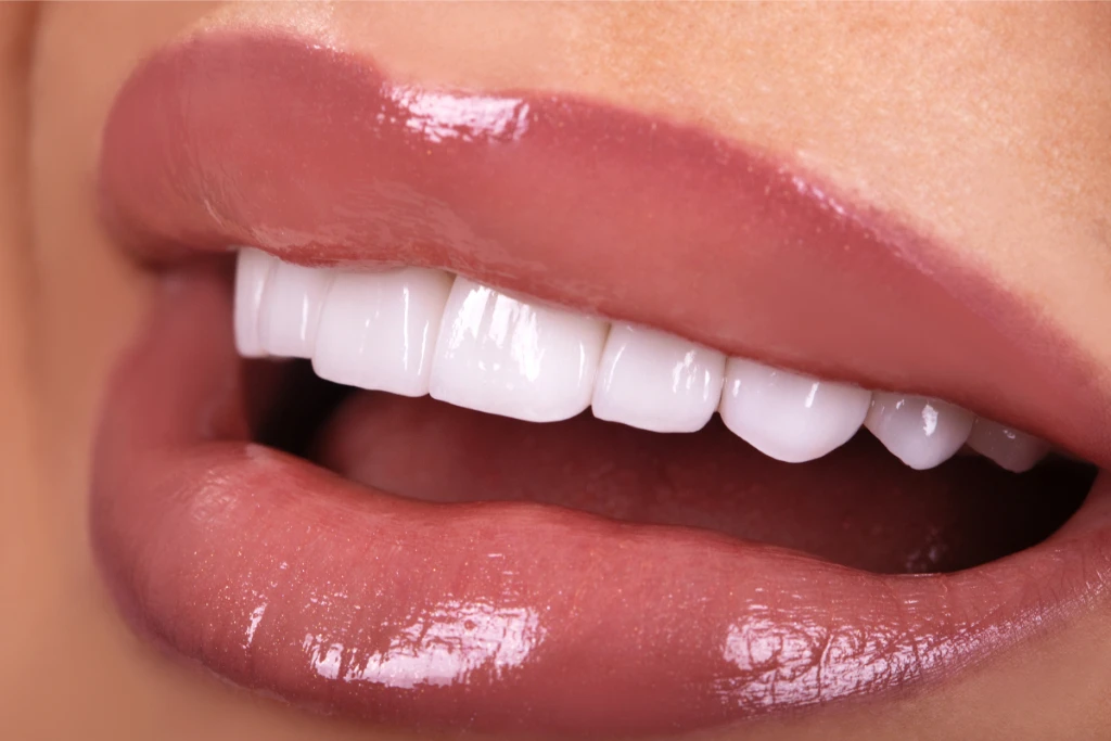All-on-6 Dental Implants All-on-6 Dental Implants